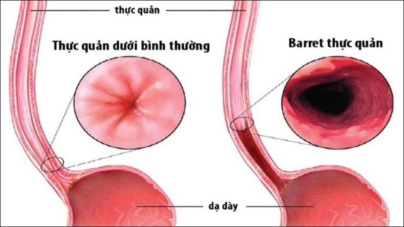 Barrett thực quản xảy ra khi các tế bào lót phần dưới thực quản dày lên và được thay thế bằng một loại tế bào khác