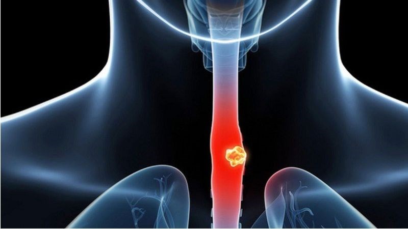 Biến chứng tiềm ẩn của barrett thực quản theo thời gian là ung thư thực quản
