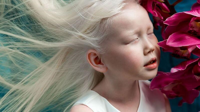 Bệnh bạch tạng là tình trạng cơ thể giảm tổng hợp melanin khiến da, tóc có màu trắng nhạt