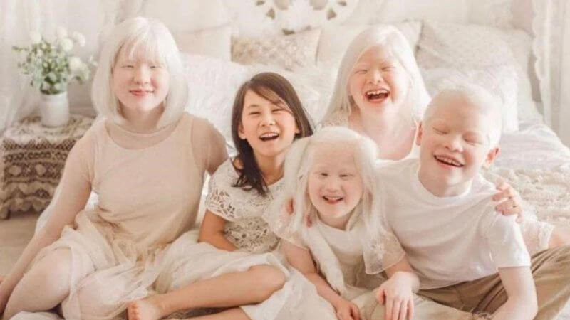 Bạch tạng là bệnh lý di truyền trong gia đình, có liên quan đến đột biến gen 