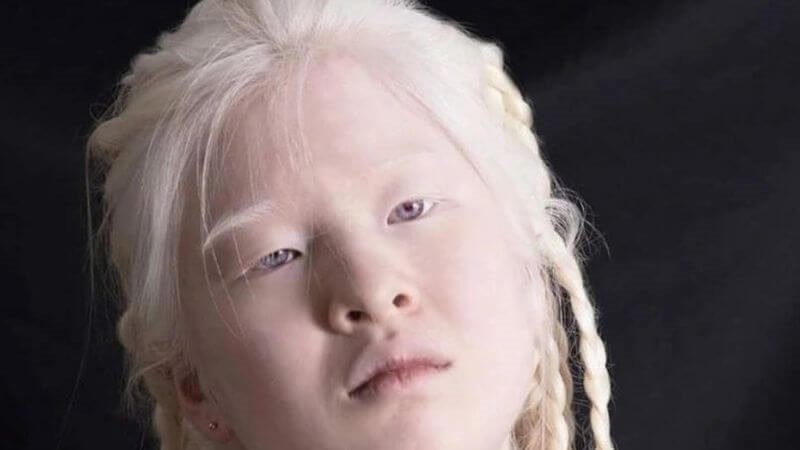 Người bệnh bạch tạng thường nhạy cảm với ánh sáng và gặp các vấn đề về chức năng của mắt