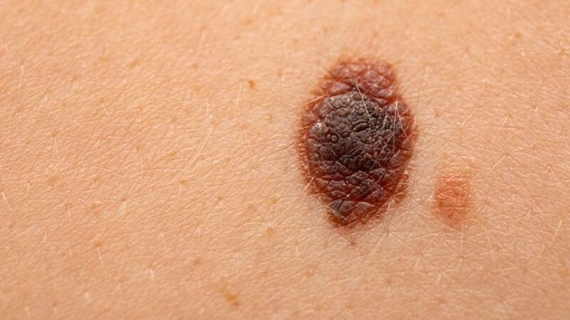 Bệnh bạch tạng có thể dẫn đến biến chứng ung thư da