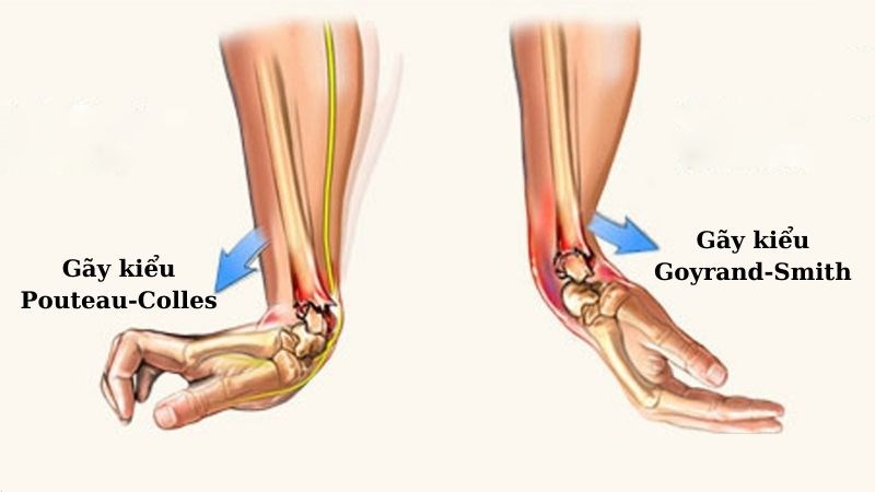 Gãy xương là biến chứng nguy hiểm khi bị bong gân cổ tay Gãy xương là biến chứng nguy hiểm khi bị bong gân cổ tay