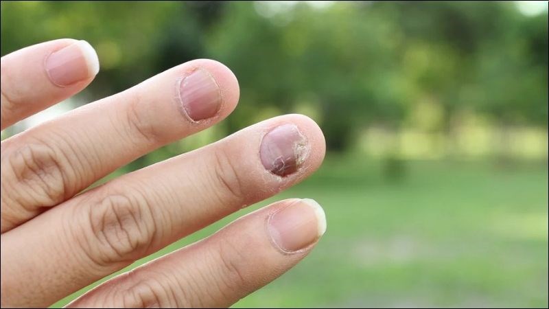 Nên cắt ngắn phần móng bị ảnh hưởng trong quá trình chăm sóc móng bị bong tróc