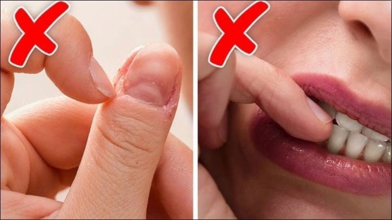 Tránh cắn móng tay để ngăn ngừa bệnh bong tróc móng