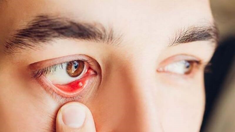 Lẹo mắt có đặc trưng là khối viêm nóng đỏ và đau phía trong mi mắt Lẹo mắt có đặc trưng là khối viêm nóng đỏ và đau phía trong mi mắt