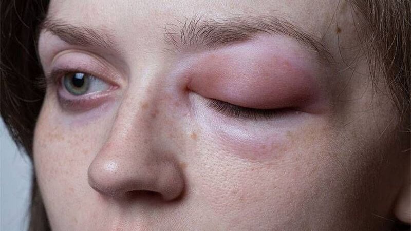 Lẹo mắt có thể dẫn đến biến chứng viêm mô tế bào trước và quanh hốc mắt Lẹo mắt có thể dẫn đến biến chứng viêm mô tế bào trước và quanh hốc mắt