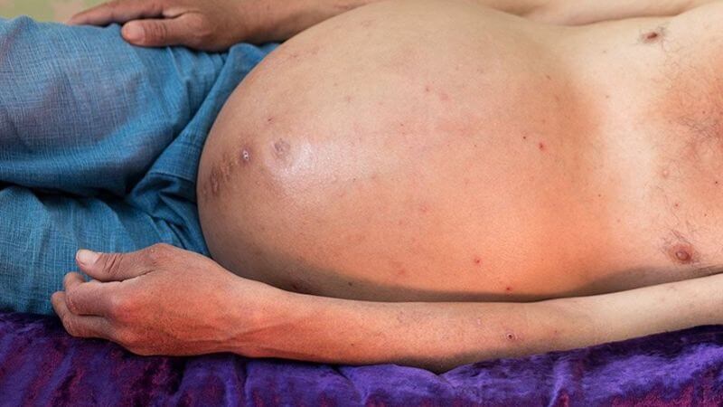 Người bệnh xơ gan có thể kèm theo xuất huyết dạ dày