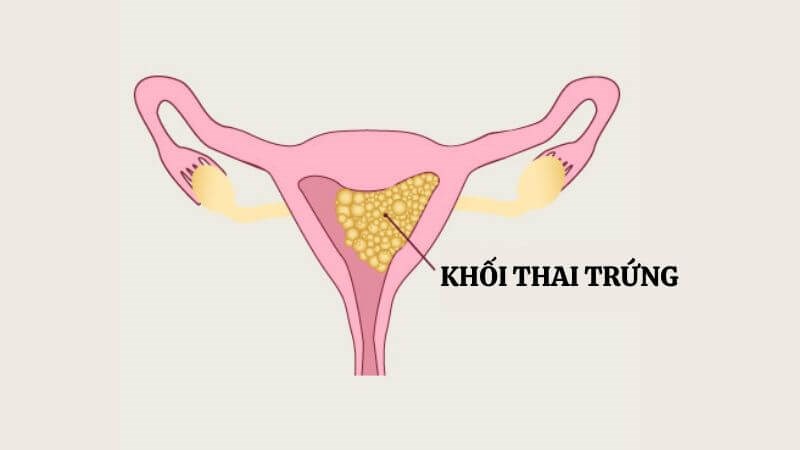 Thai trứng là bệnh lý u lành tính tại nhau thai tạo thành các túi nước nhỏ giống như chùm nho