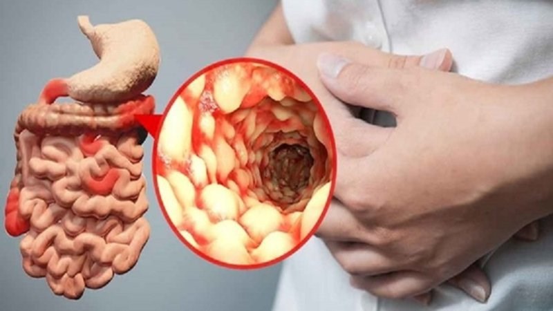 Bệnh viêm ruột có thể dẫn đến hấp thụ vitamin D kém Bệnh viêm ruột có thể dẫn đến hấp thụ vitamin D kém
