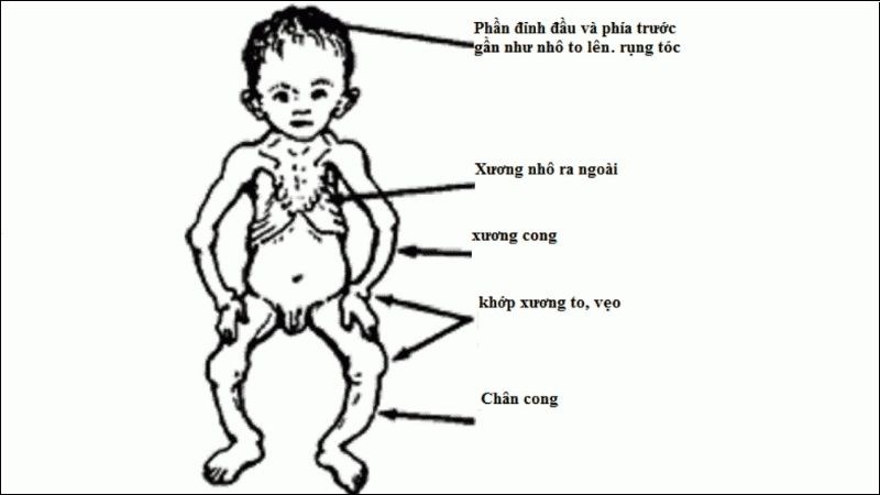Một số dấu hiệu khi mắc bệnh còi xương Một số dấu hiệu khi mắc bệnh còi xương