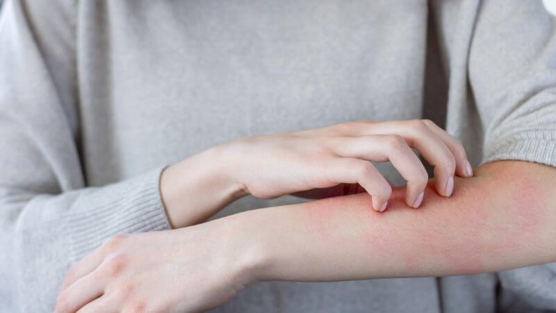 Người có tiền sử dị ứng thức ăn có nguy cơ bệnh da vảy cá cao hơn bình thường