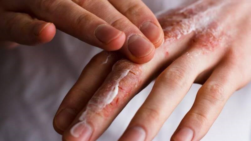 Điều trị tại chỗ giúp cải thiện tình trạng khô da, bong tróc vảy và hạn chế biến chứng của bệnh