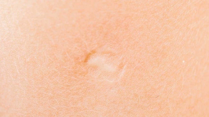 Cách tốt nhất để ngừa bệnh đậu mùa là tiêm vắc-xin đậu mùa. 