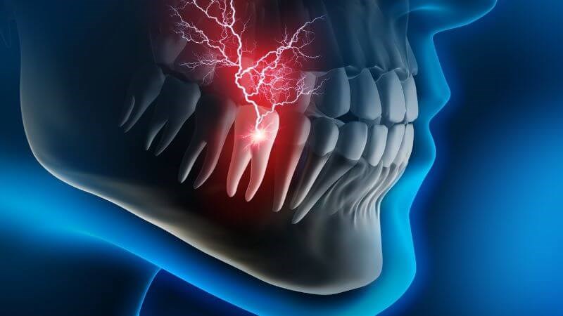 Đau răng là tình trạng xuất hiện các cơn đau nhức trong răng và quanh răng