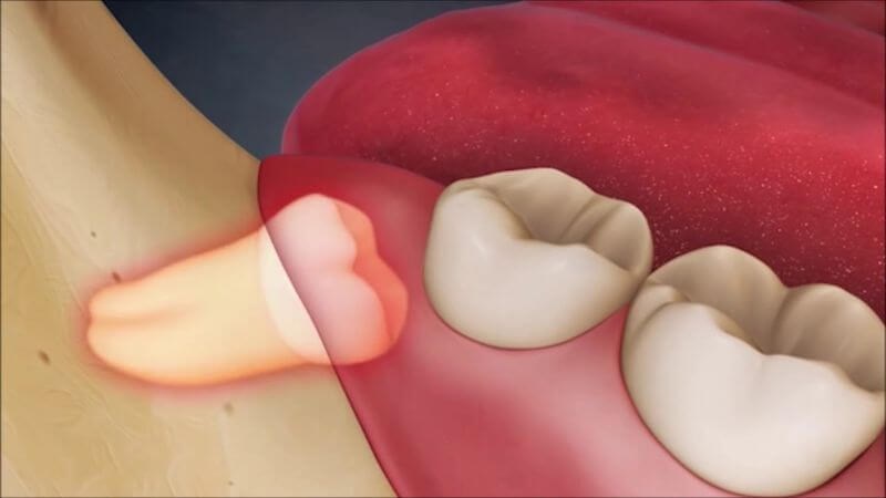 Răng khôn mọc lệch là nguyên nhân gây đau răng