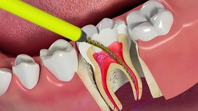 Lấy tủy răng (triệt tủy) giúp điều trị đau răng