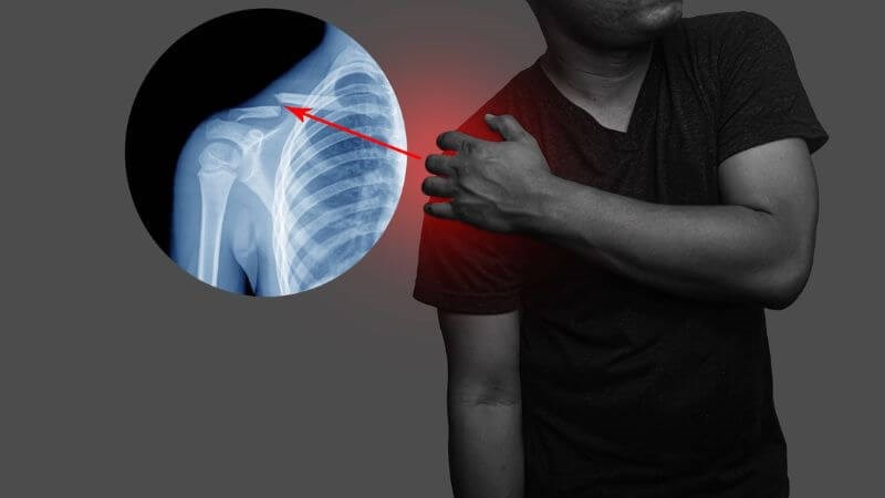 Gãy xương đòn là tình trạng mất sự liên tục về hình dạng xương đòn