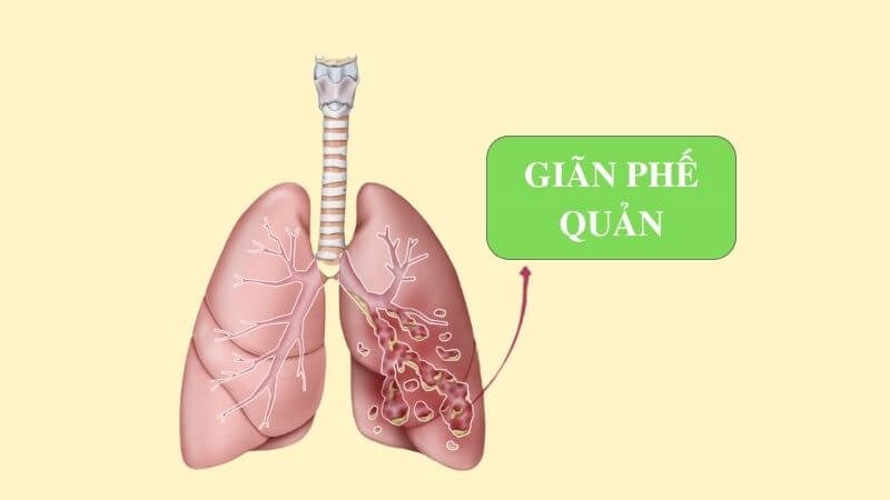 Giãn phế quản là tình trạng các ống phế nang giảm độ đàn hồi, giãn rộng gây giảm thông khí Giãn phế quản là tình trạng các ống phế nang giảm độ đàn hồi, giãn rộng gây giảm thông khí