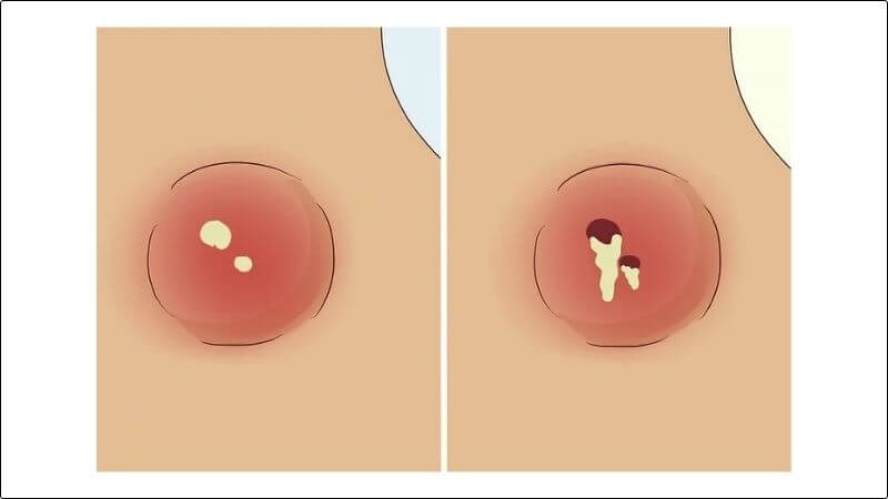 Sau khi xuất hiện nhân màu trắng, nhọt sẽ tự vỡ Sau khi xuất hiện nhân màu trắng, nhọt sẽ tự vỡ