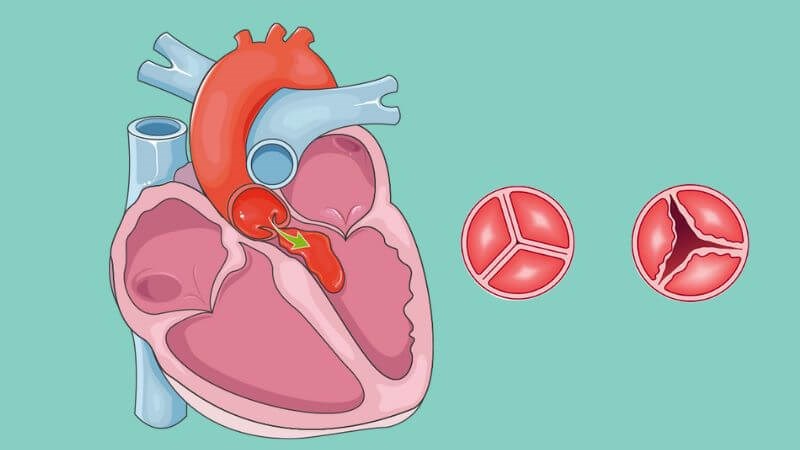 Hở van động mạch chủ là tình trạng van tim không đóng chặt lại được sau khi tim co bóp tống máu Hở van động mạch chủ là tình trạng van tim không đóng chặt được sau khi tim co bóp
