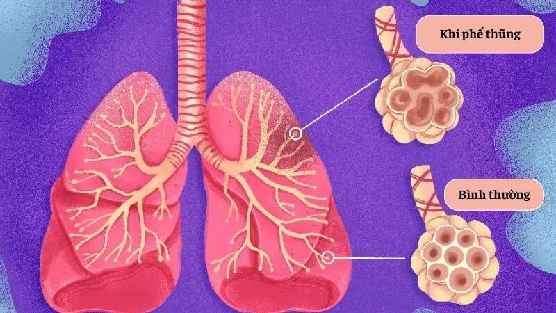 Khí phế thũng là tình trạng các túi phế nang bị giãn rộng và vỡ ra