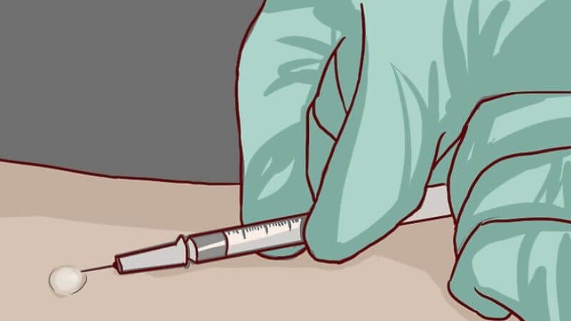 Bác sĩ có thể dựa vào phản ứng Mantoux để chẩn đoán bệnh lao