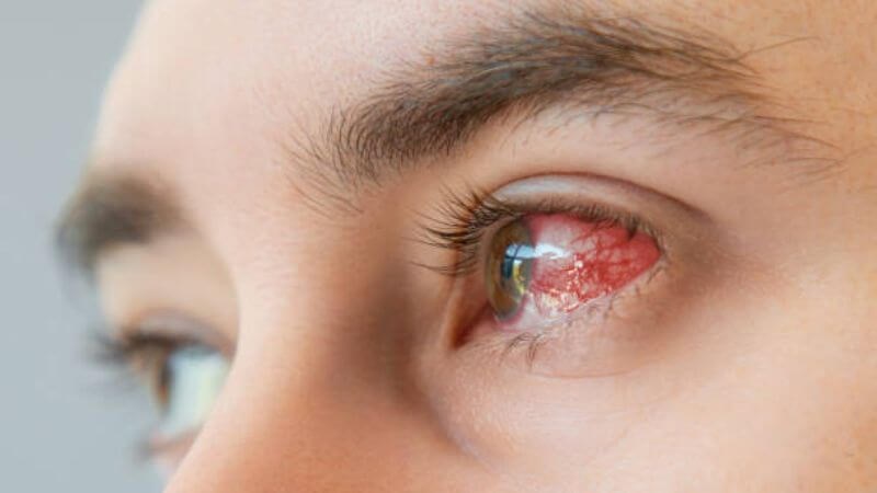 Loét giác mạc là tình trạng viêm đỏ và hình thành các vết loét trên bề mặt giác mạc
