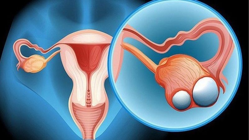 Phẫu thuật cắt bỏ tử cung không gây mãn kinh ngay lập tức