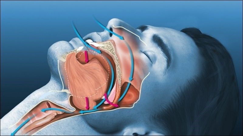 Người mắc hội chứng ngưng thở khi ngủ có nguy cơ xuất hiện các đợt mộng du cao hơn