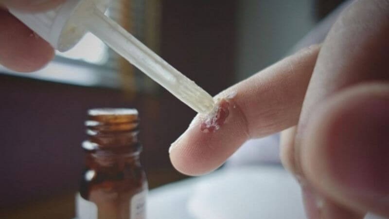 Thuốc bôi chứa axit salicylic nồng độ thấp có thể điều trị mụn cóc tại nhà