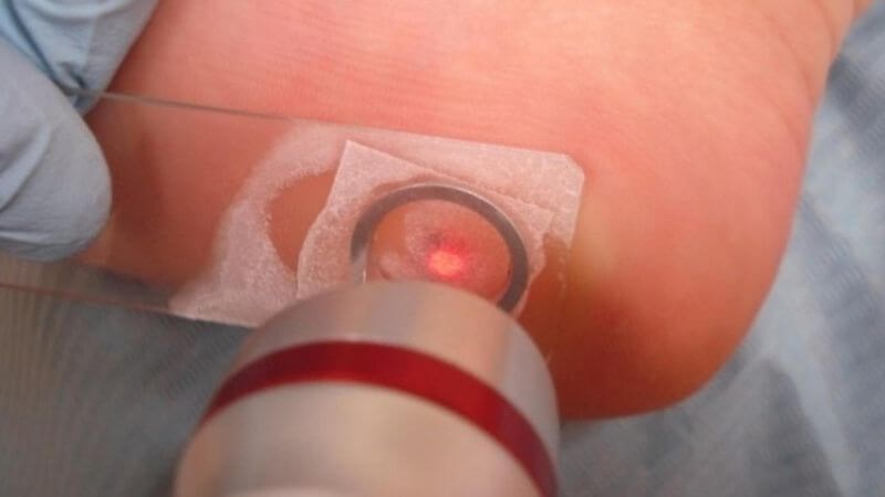 Sử dụng laser có thể điều trị bệnh mụn cóc