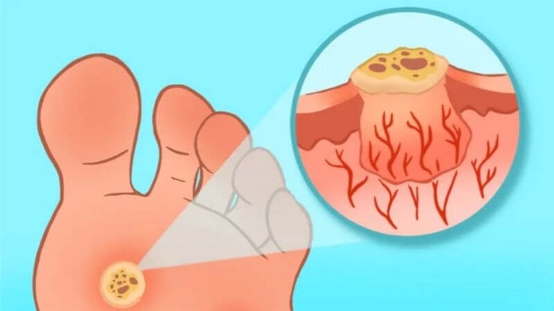 Mụn cóc ở chân khiến người bệnh gặp khó khăn khi đi lại
