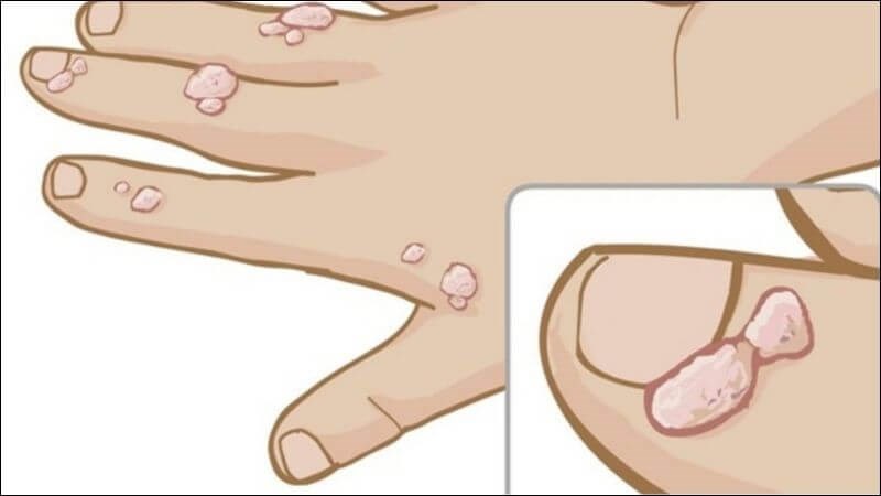 Mụn cóc quanh móng là tổn thương thô ráp, sần sùi ở vùng rìa móng