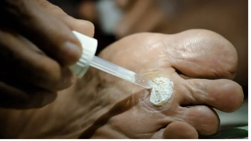 Dùng acid salicylic để điều trị mụn cóc