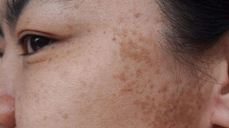 Nám da là tình trạng làn da xuất hiện những biến đổi sắc tố màu nâu hoặc xám
