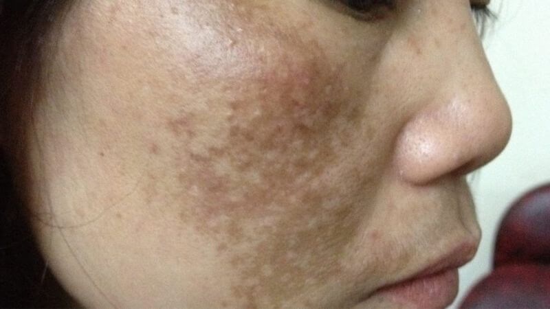 Nám da đậm màu và tăng kích thước là dấu hiệu cần đến khám bác sĩ