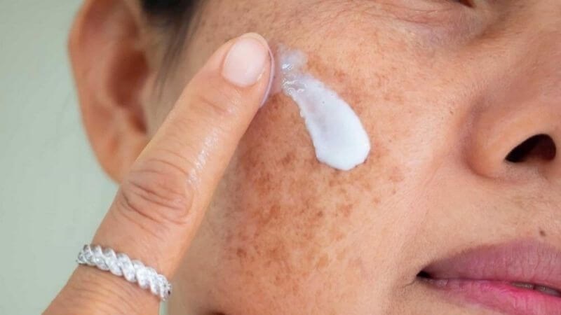 Có thể sử dụng các loại thuốc bôi để chữa nám da