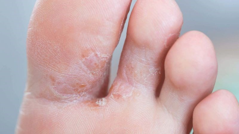 Bệnh nấm kẽ chân (nước ăn chân) – bệnh thường gặp mùa mưa bạn cần biết