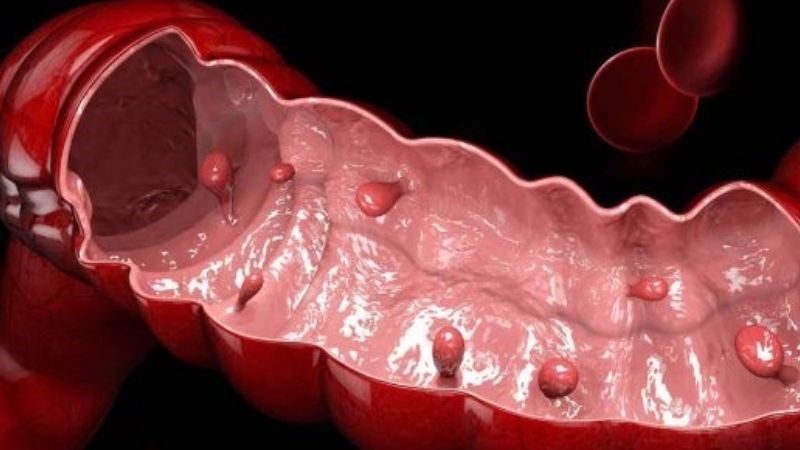 Polyp đại tràng là sự phát triển những cụm tế bào nhỏ trên lớp lót bên trong của đại tràng hoặc trực tràng Polyp đại tràng là sự phát triển tế bào trên lớp lót bên trong của đại tràng hoặc trực tràng