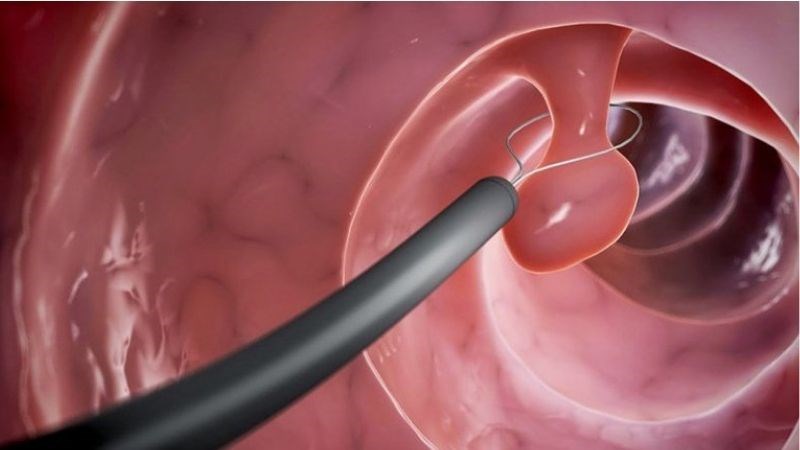 Cắt bỏ polyp thông qua nội soi đại tràng có thể được thực hiện không đau và nhanh chóng Cắt bỏ polyp thông qua nội soi đại tràng có thể được thực hiện không đau và nhanh chóng