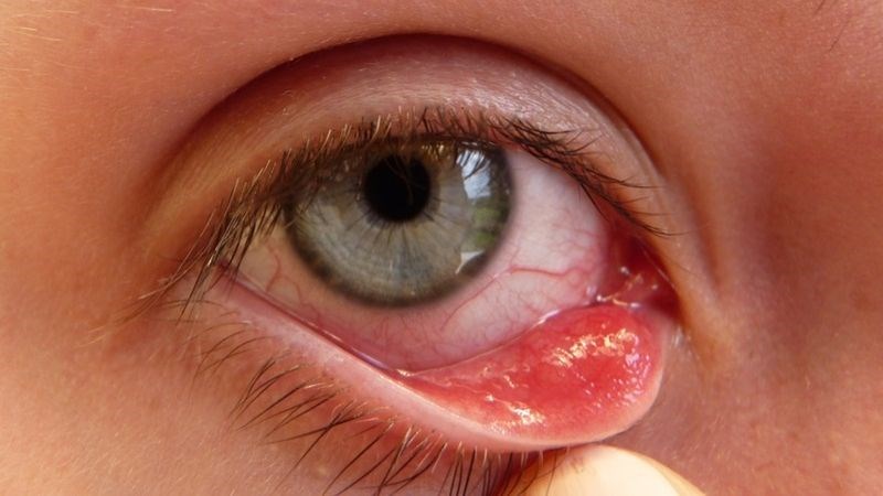 Rận mu có thể gây biến chứng viêm kết mạc mắt