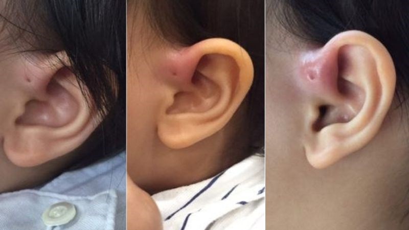 Rò luân nhĩ khi bị viêm sẽ gây triệu chứng sưng, nóng, đỏ, đau