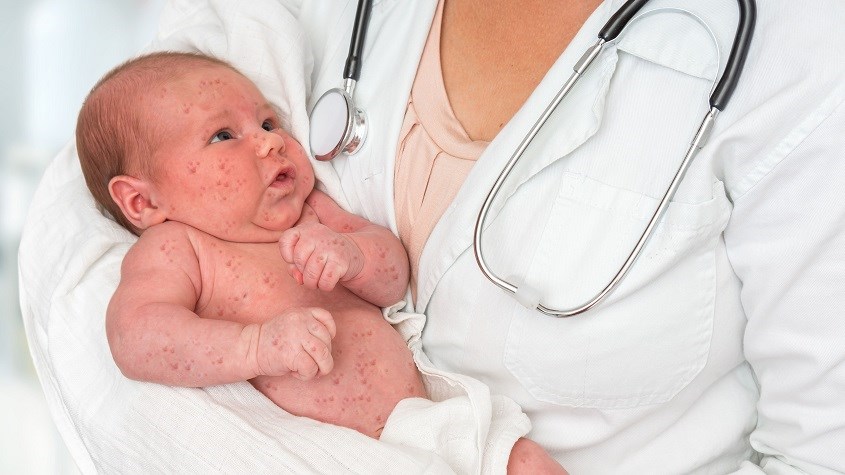 Rubella có nhiều điểm tương đồng với bệnh sởi thông thường. Nguồn: Verywellhealth