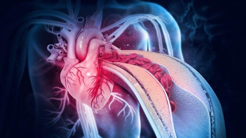 Rung nhĩ không được điều trị kịp thời có thể dẫn đến nhồi máu cơ tim Rung nhĩ không được điều trị kịp thời có thể dẫn đến nhồi máu cơ tim