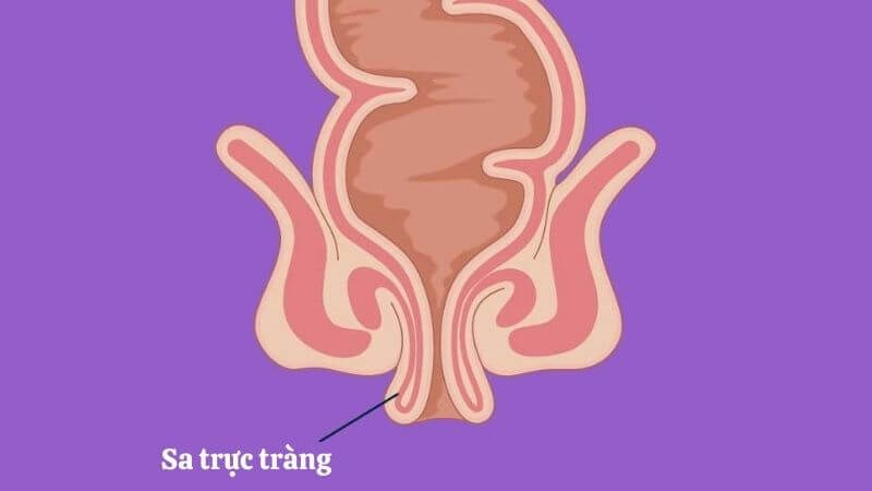 Sa trực tràng là tình trạng một phần hoặc toàn bộ thành trực tràng bị bị lộn ngược ra ngoài Sa trực tràng là tình trạng một phần hoặc toàn bộ thành trực tràng bị bị lộn ngược ra ngoài