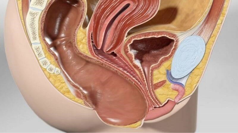 Sa trực tràng không toàn toàn thường có khối nhỏ tại hậu môn và đẩy vào trong được Sa trực tràng không toàn toàn thường có khối nhỏ tại hậu môn và đẩy vào trong được