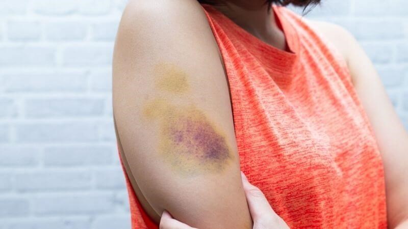 Cơ thể hay bị bầm tím là một trong những triệu chứng của bệnh scorbut