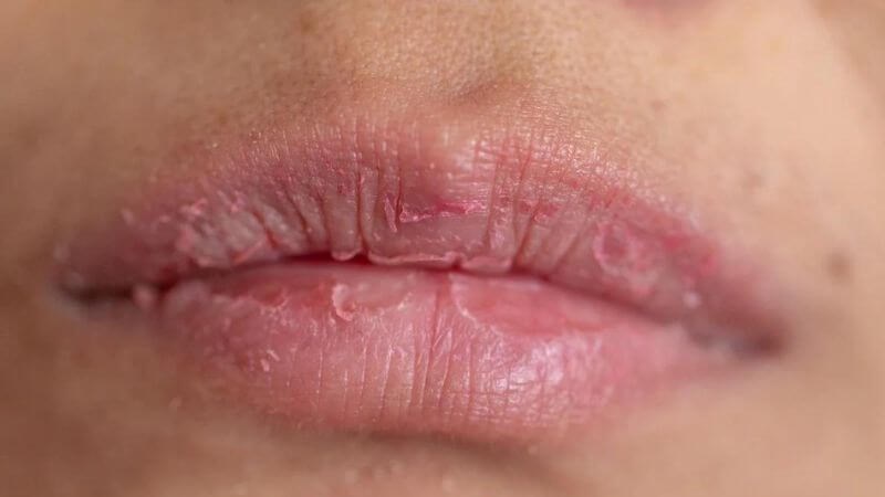 Môi khô, đắng miệng là dấu hiệu của mất nước ở người bệnh tả Môi khô, đắng miệng là dấu hiệu của mất nước ở người bệnh tả