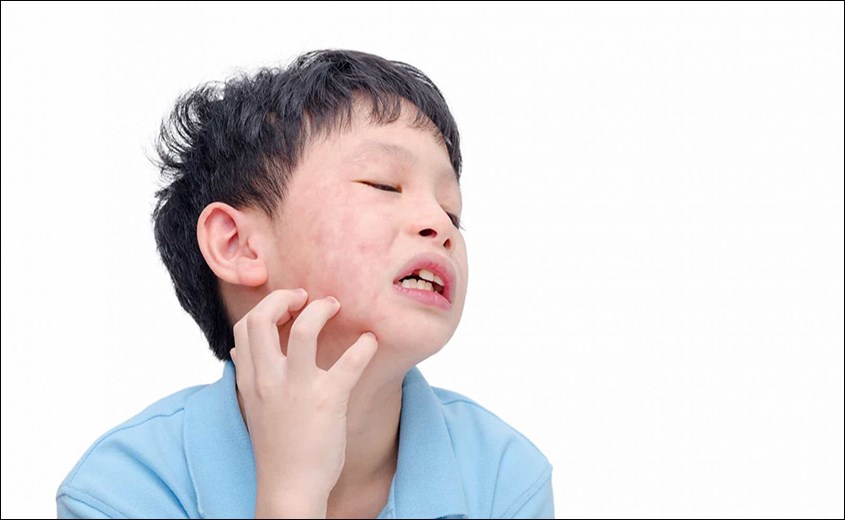 bệnh thường gặp ở trẻ mầm non sẽ có bệnh quai bị